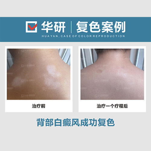 合肥华研白癜风医院